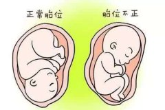 胎位不正的危害