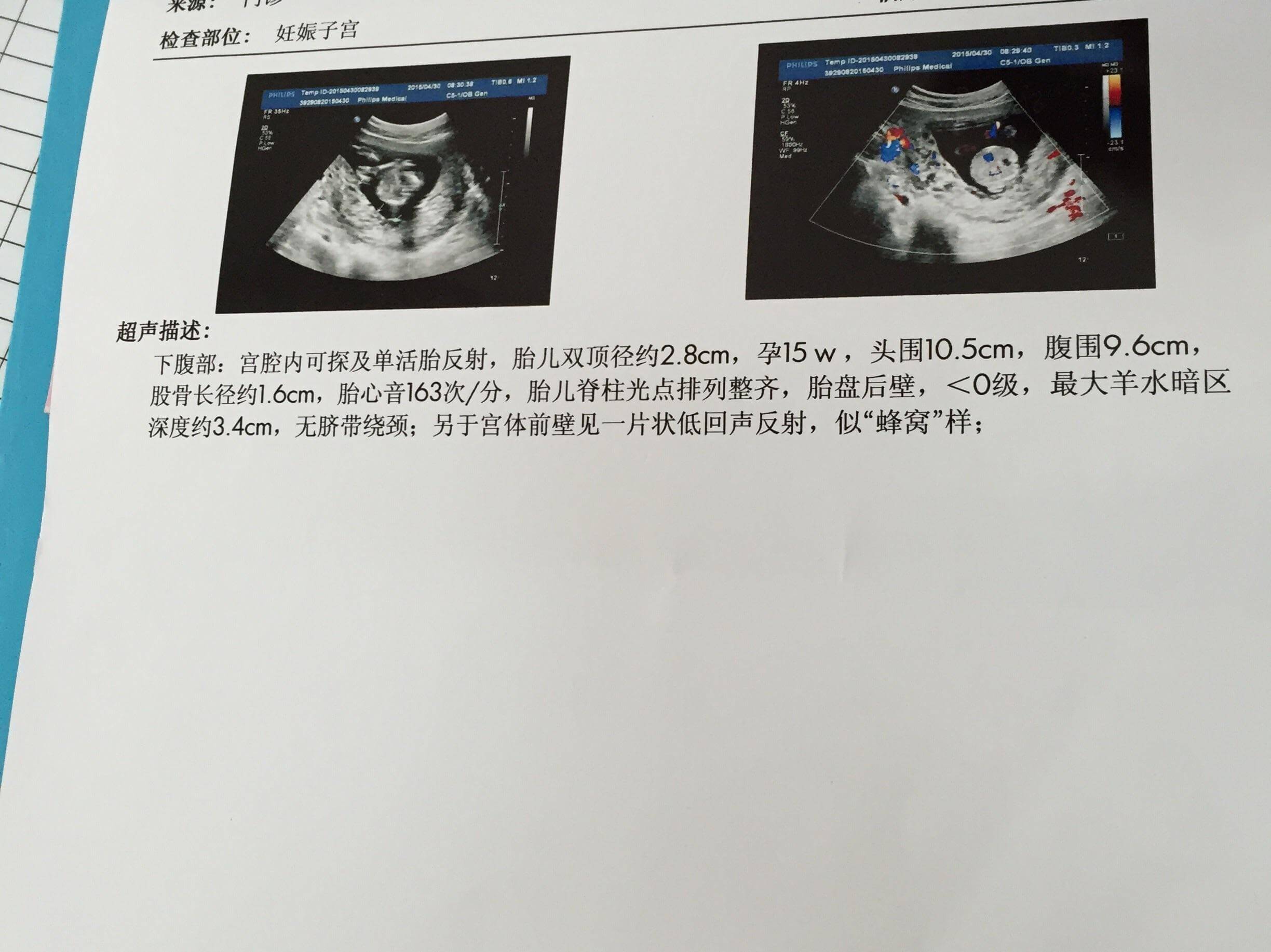 什么是第二个三月期的超声检查呢？
