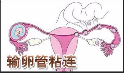 女性输卵管堵塞可以做试管婴儿吗 双侧输卵管堵塞能做试管婴儿吗
