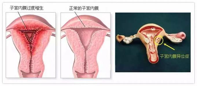 什么原因导致子宫内膜增厚？为什么会出现子宫内膜增厚？