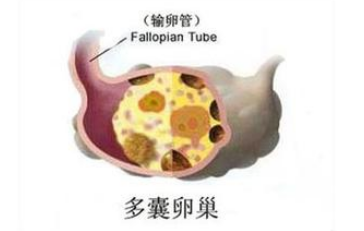 多囊怀孕后怎么保胎？多囊对怀孕能造成什么影响？