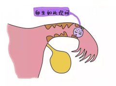 输卵管造影会有并发症吗？造影后会发生感染么？