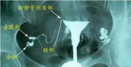 输卵管造影的最佳时间？有哪些需要注意的事项？