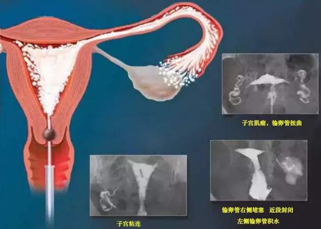 做通液好还是造影好？哪一种更容易怀孕？