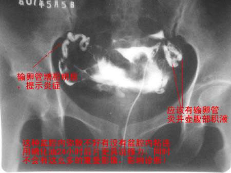检查输卵管造影贵吗？大概要花多少钱？