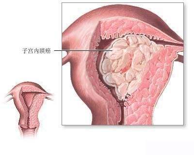 绝经后子宫内膜增厚怎么治疗？子宫内膜增厚有哪些治疗方法？