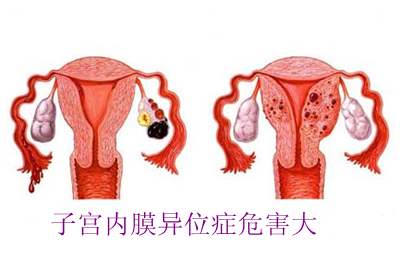 子宫内膜异位症怎么查？子宫内膜异位症会引起不孕不育吗？
