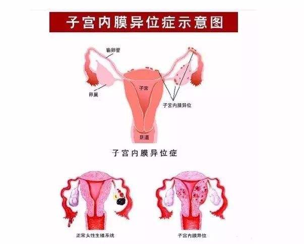 子宫内膜异位症能怀上孩子么？子宫内膜异位症对怀孕有什么影响？