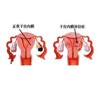 子宫内膜异位症的后果是什么？子宫内膜异位症会有哪些症状？