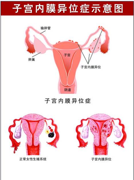 子宫内膜异位怎么形成的？为什么会出现子宫内膜异位症？