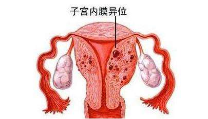 子宫内膜炎怎么治疗？什么治疗方式比较好？