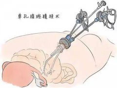 腹腔镜手术怎么做的 多久恢复