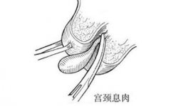 宫颈息肉是怎么回事