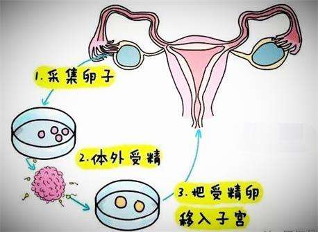 试管婴儿是怎么在体外受精的？