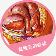 盆腔炎有什么症状？