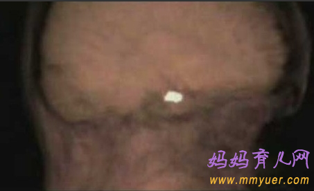 卵子排出全过程 卵子排出的真实图片 