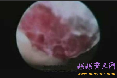 卵子排出全过程 卵子排出的真实图片 