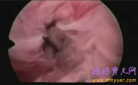 卵子排出全过程 卵子排出的真实图片 