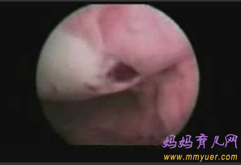 卵子排出全过程 卵子排出的真实图片 