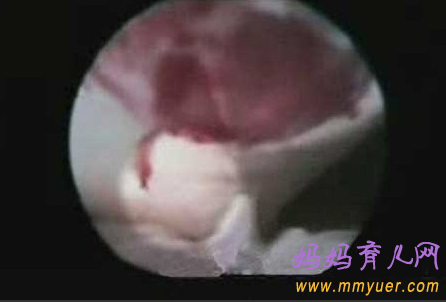 卵子排出全过程 卵子排出的真实图片 