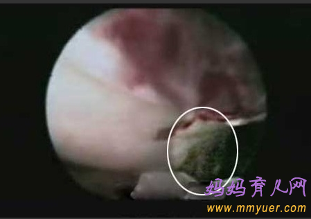 卵子排出全过程 卵子排出的真实图片 