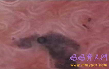卵子排出全过程 卵子排出的真实图片 