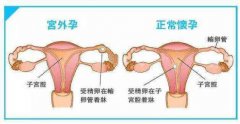 宫外孕怎么治疗？