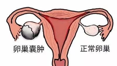 武汉卵巢囊肿还能做试管婴儿吗？