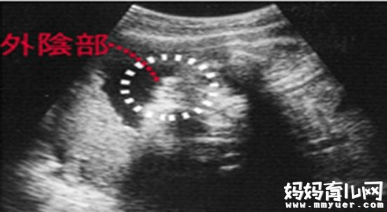 四维单子上有男女暗示 我告诉你四维彩超怎么分辨男女 