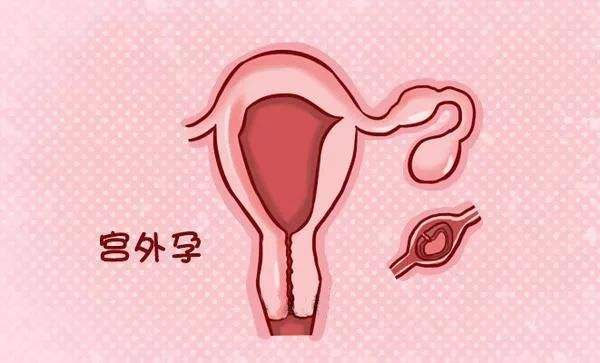 宫外孕造成出血