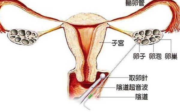 最低预算15万!俄罗斯第三代试管婴儿费用包含这5大部分