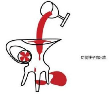 功能性子宫出血