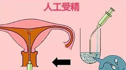 人工授精和试管婴儿的区别，二胎大家准备好了吗？