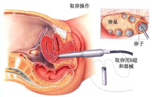 取卵