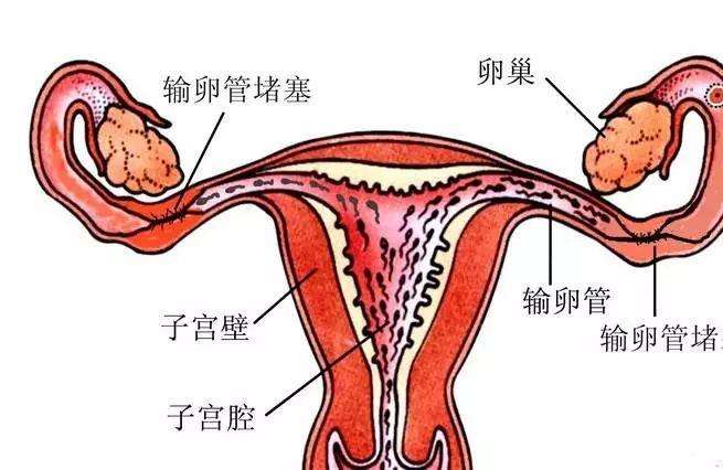 输精管堵塞会引起不孕?专家在线