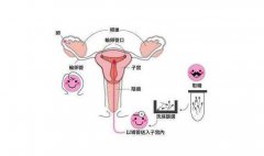 哪些人适合选择人工授精助孕？