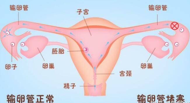 输卵管堵塞的症状