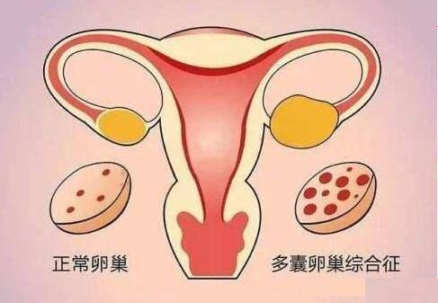 多囊卵巢综合症