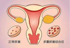 多囊卵巢综合症的原因及症状 它能治好吗