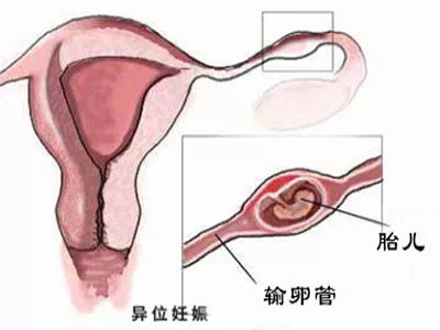 成都做试管婴儿会不会发生宫外孕？