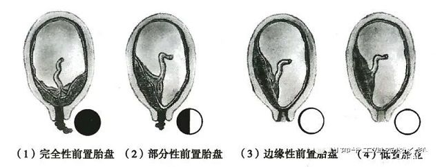 胎盘低置的分类