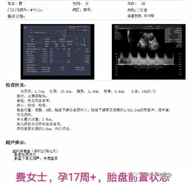 胎盘低置案例一