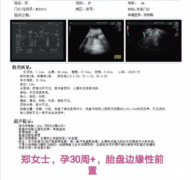 胎盘低置案例二