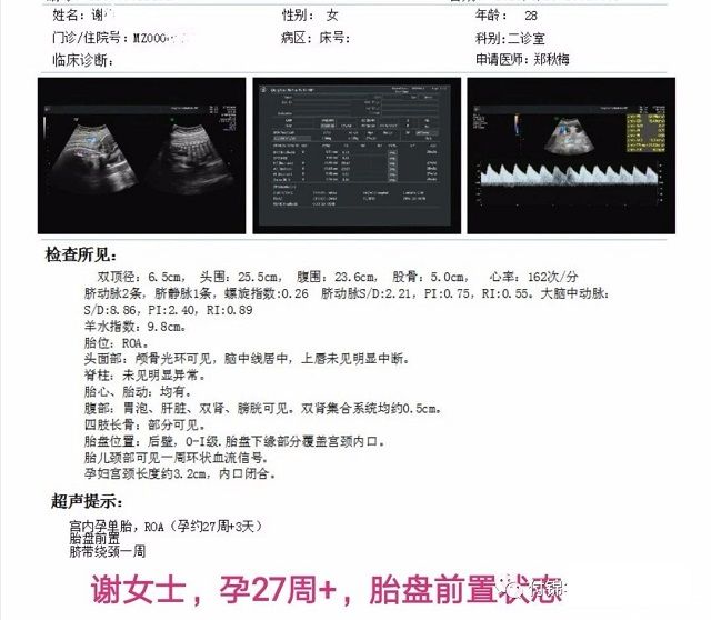 胎盘低置案例二