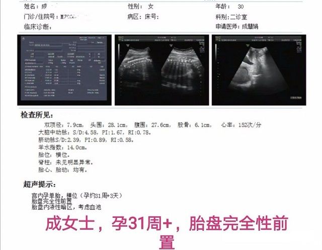 胎盘边缘性前置案例三