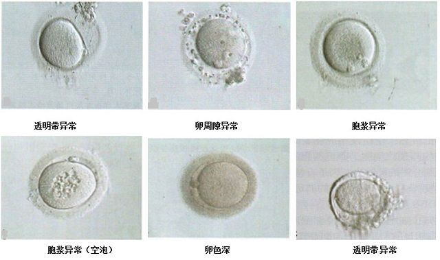 异常形态卵子