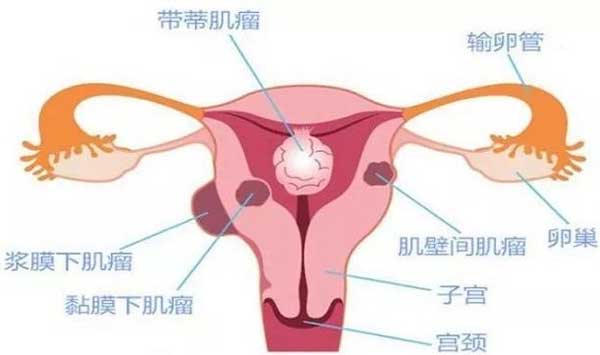子宫肌瘤的分型