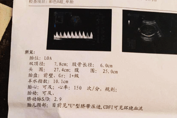 胎位loa和lop是什么意思 看了本文就知道 
