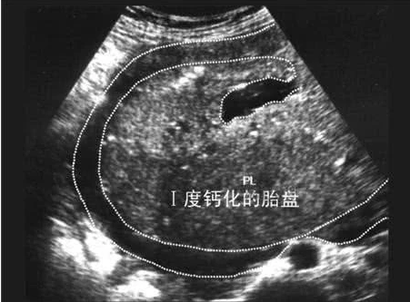 试管婴儿图片
