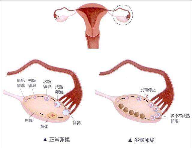 武汉多囊卵巢试管婴儿移植侯多久着床？成功率多大？